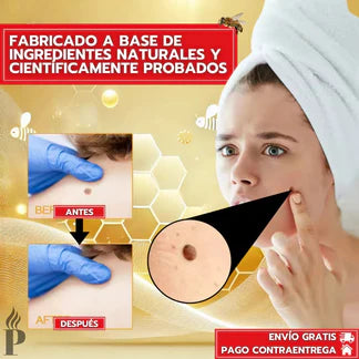 Eliminador De Verrugas